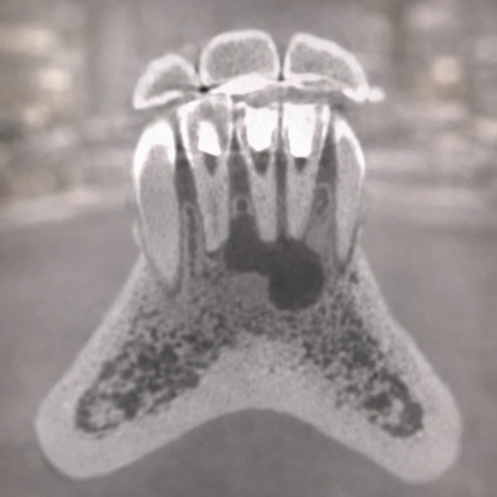 Лечение каналов и травма зубов